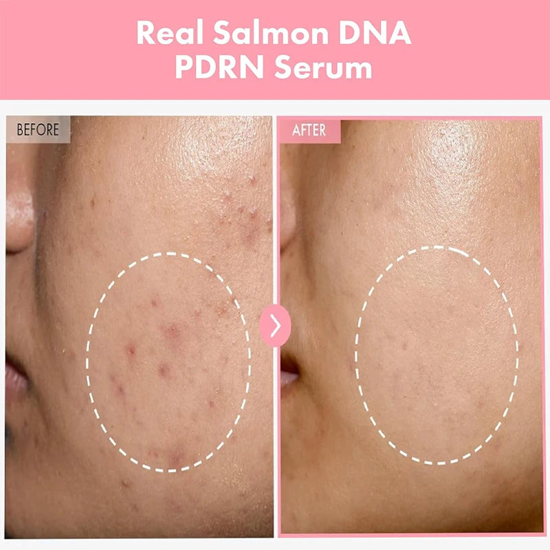 Complex Peptide Acne Serum PDRN Collagen Shrink Pores Fade Melanin Smooth Brightening Skin Korean Skincare Products